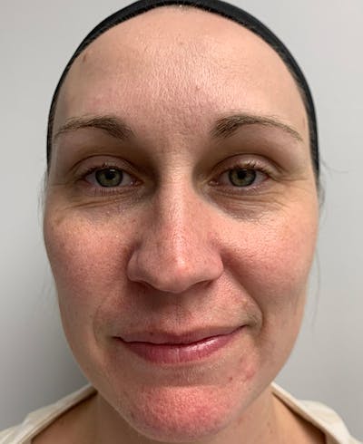 Halo Laser Before & After Gallery - Patient 55260911 - Image 1