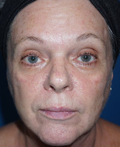 Halo Laser Before & After Gallery - Patient 55260912 - Image 1