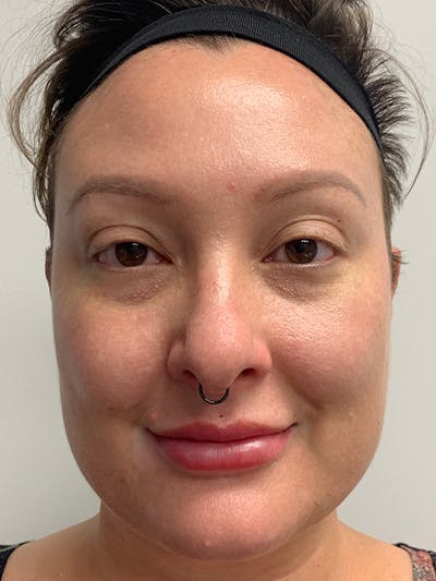 Chemical Peels Before & After Gallery - Patient 55482768 - Image 2