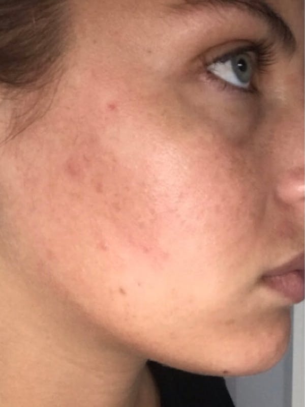 Chemical Peels Gallery - Patient 55482769 - Image 2