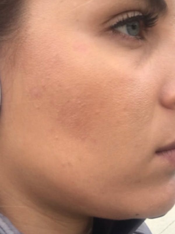 Chemical Peels Before & After Gallery - Patient 55482769 - Image 4