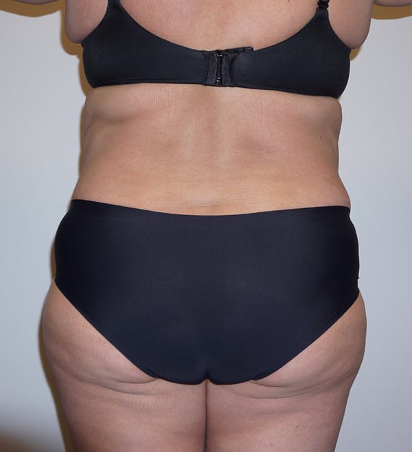 LPG Endermologie Before & After Gallery - Patient 55482786 - Image 2