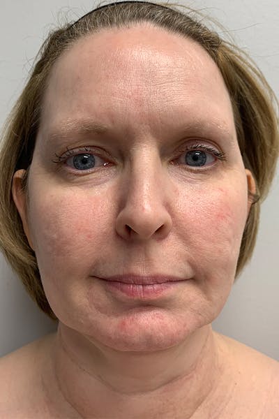 Contour TRL Before & After Gallery - Patient 55482935 - Image 1