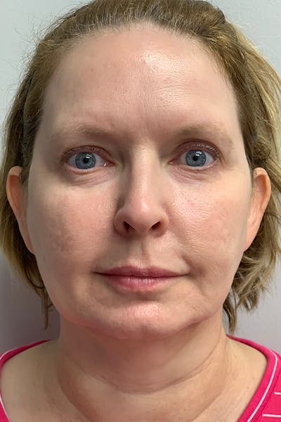 Contour TRL Before & After Gallery - Patient 55482935 - Image 2