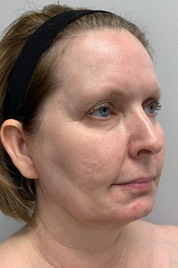 Contour TRL Before & After Gallery - Patient 55482935 - Image 3