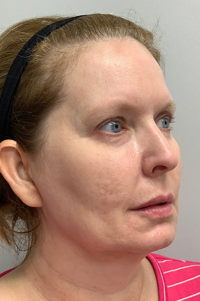 Contour TRL Before & After Gallery - Patient 55482935 - Image 4