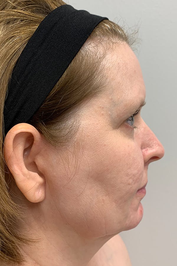 Contour TRL Before & After Gallery - Patient 55482935 - Image 5