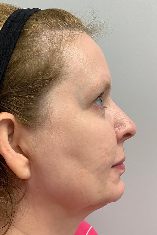 Contour TRL Before & After Gallery - Patient 55482935 - Image 6