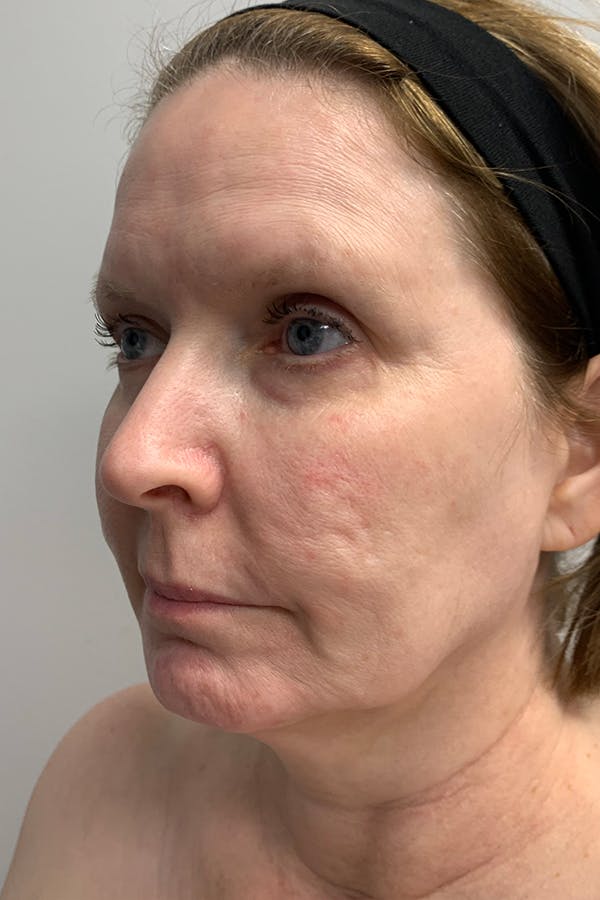 Contour TRL Before & After Gallery - Patient 55482935 - Image 7