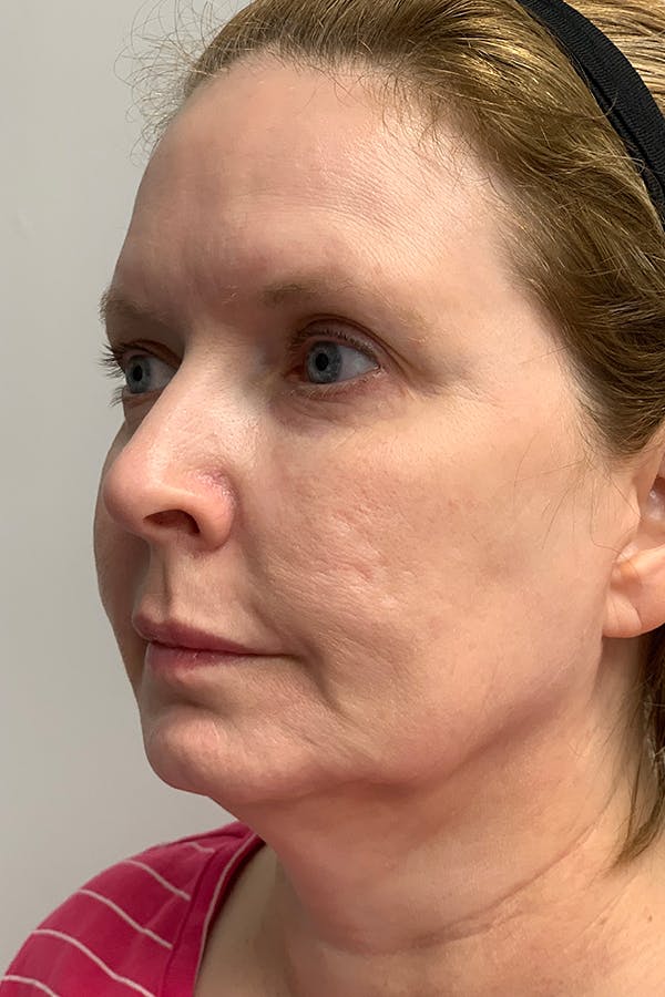 Contour TRL Before & After Gallery - Patient 55482935 - Image 8