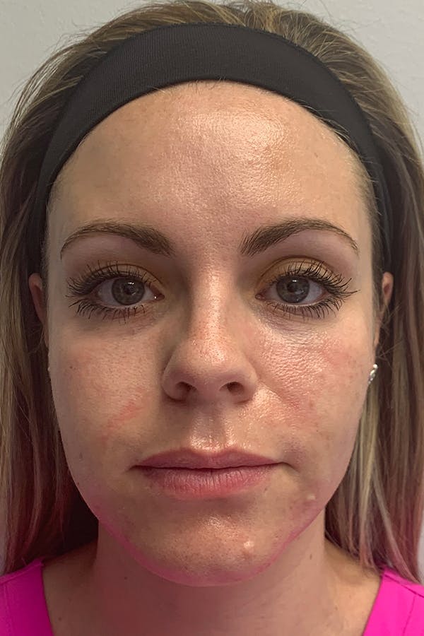 Contour TRL Before & After Gallery - Patient 55482933 - Image 1