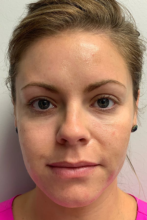 Contour TRL Before & After Gallery - Patient 55482933 - Image 2