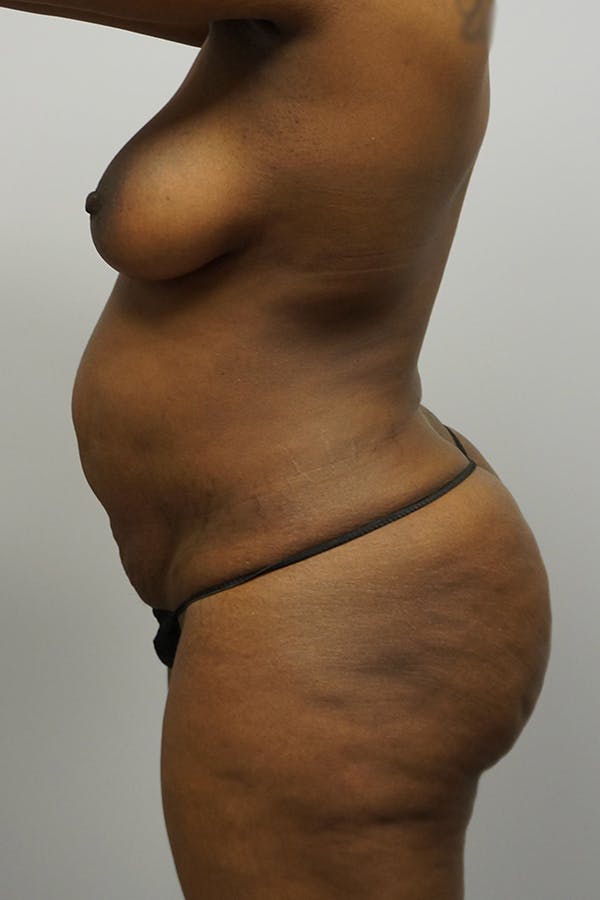Tummy Tuck Gallery - Patient 67095065 - Image 3