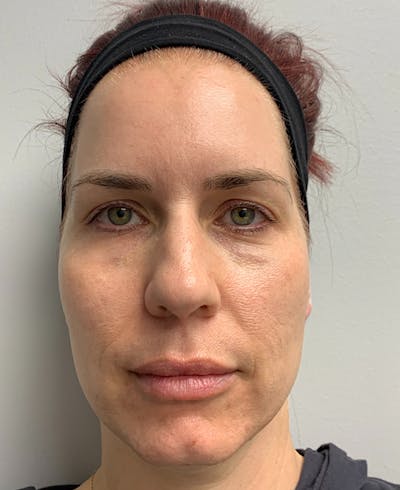 Halo Laser Before & After Gallery - Patient 67745516 - Image 1