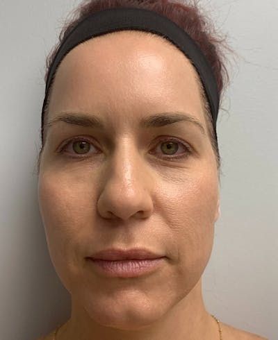 Halo Laser Before & After Gallery - Patient 67745516 - Image 2