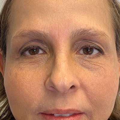3D Microblading/ Henna Brows Gallery - Patient 91514601 - Image 1