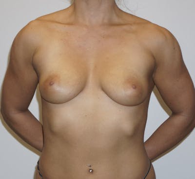 Breast Augmentation Before & After Gallery - Patient 120177631 - Image 1