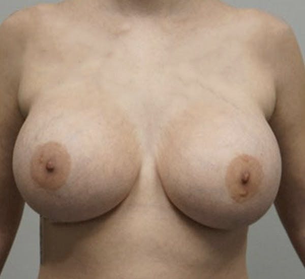 Breast Augmentation Before & After Gallery - Patient 120177630 - Image 2