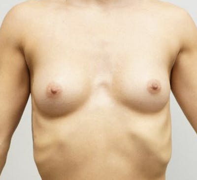 Breast Augmentation Before & After Gallery - Patient 120177964 - Image 1