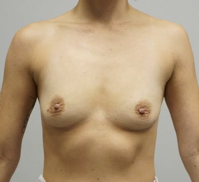 Breast Augmentation Before & After Gallery - Patient 120177983 - Image 1