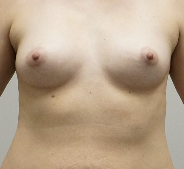 Breast Augmentation Before & After Gallery - Patient 120177991 - Image 1