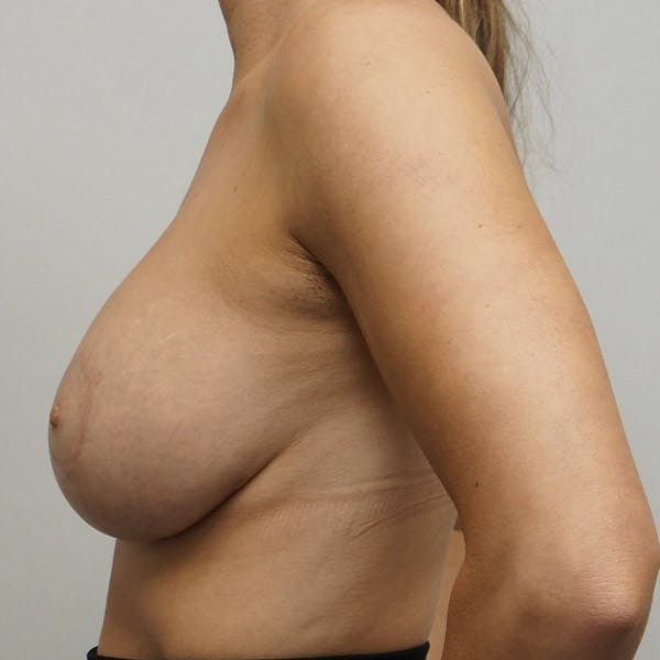 Breast Augmentation with Mastopexy Gallery - Patient 120178041 - Image 4