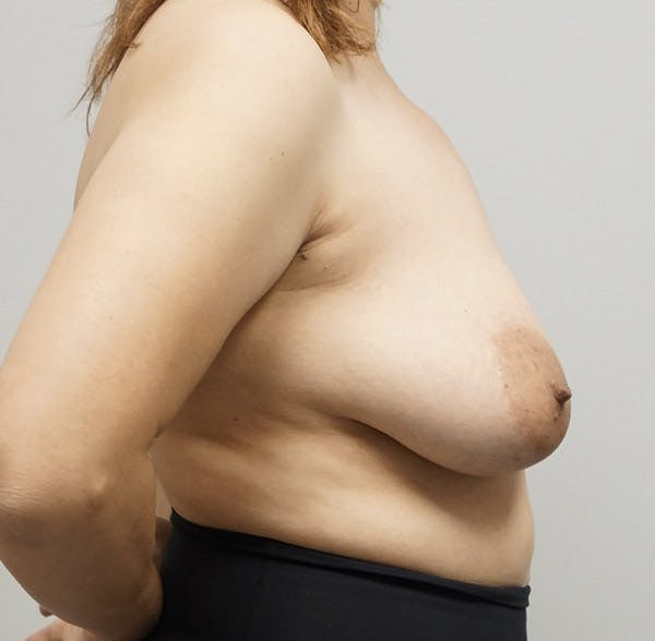 Breast Lift Before & After Gallery - Patient 120178098 - Image 3
