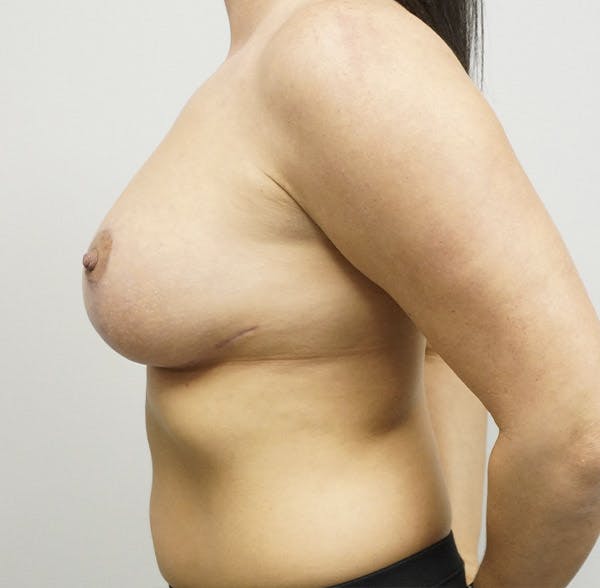 Breast Lift Before & After Gallery - Patient 120178109 - Image 4