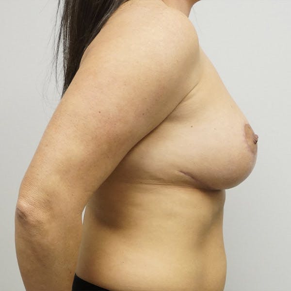 Breast Revision Surgery Before & After Gallery - Patient 120178450 - Image 4