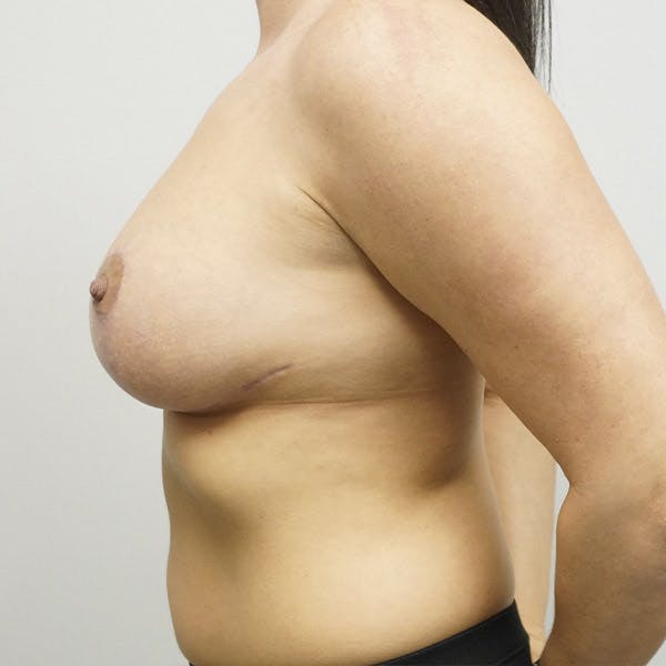 Breast Revision Surgery Before & After Gallery - Patient 120178450 - Image 6