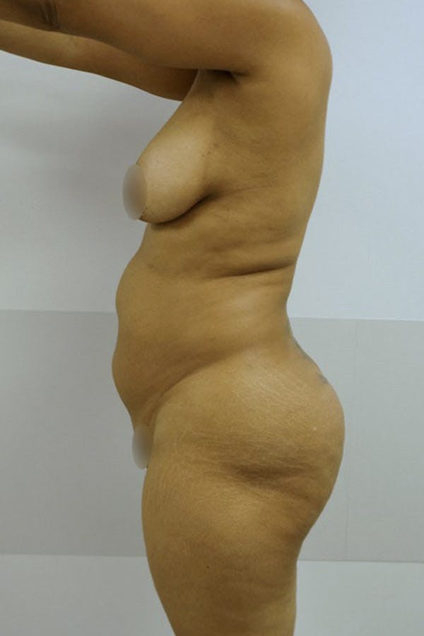 Liposuction Before & After Gallery - Patient 120178629 - Image 3