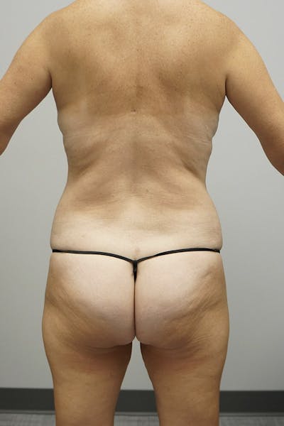 Liposuction Gallery - Patient 120178628 - Image 2