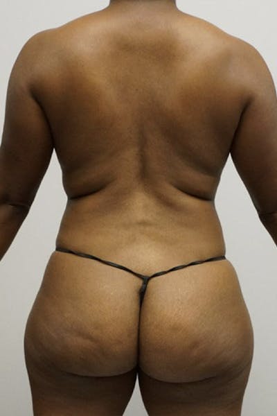 Liposuction Before & After Gallery - Patient 120178664 - Image 1