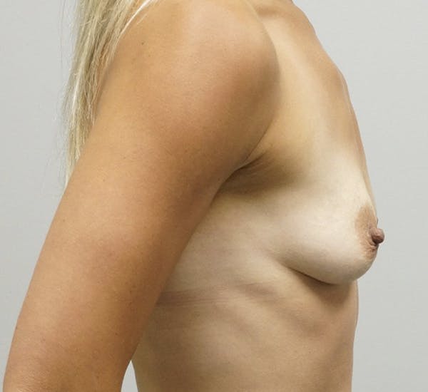 Breast Augmentation Gallery - Patient 67095982 - Image 3