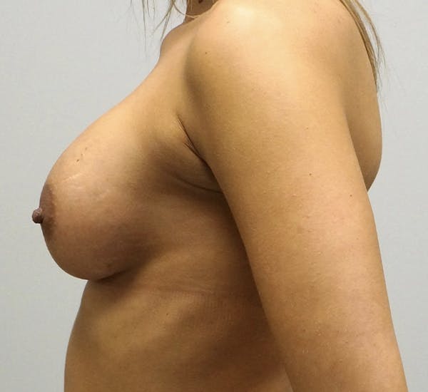Breast Augmentation Before & After Gallery - Patient 120410785 - Image 4