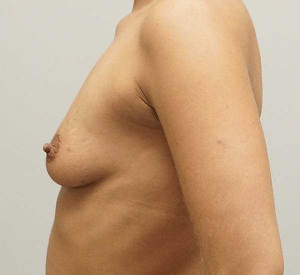 Breast Augmentation Before & After Gallery - Patient 120410785 - Image 3