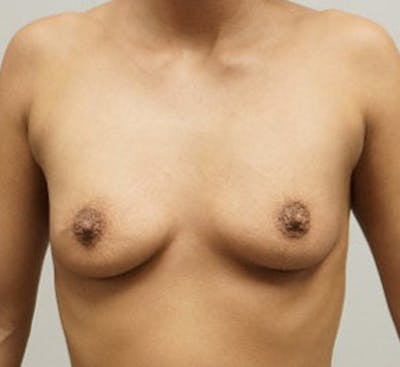 Breast Augmentation Before & After Gallery - Patient 120410785 - Image 1