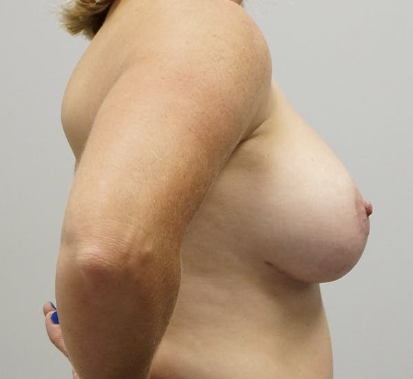 Breast Augmentation with Mastopexy Gallery - Patient 120410840 - Image 4