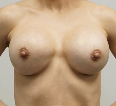 Breast Revision Surgery Before & After Gallery - Patient 120410859 - Image 2