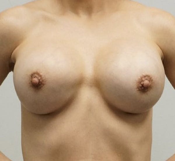 Breast Revision Results in Houston with Dr. Lind.