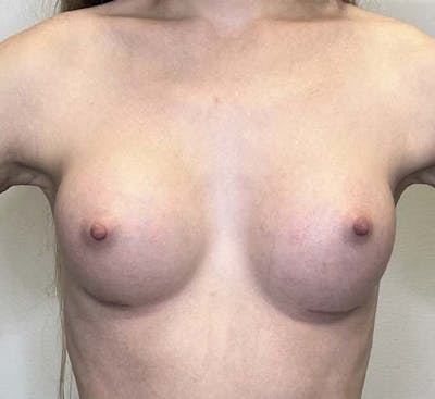 Breast Augmentation Before & After Gallery - Patient 122244584 - Image 2