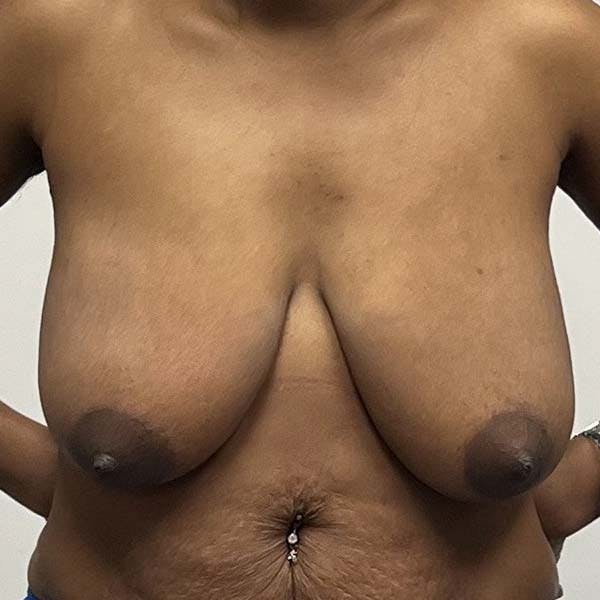 Breast Reduction Before & After Gallery - Patient 122244593 - Image 1
