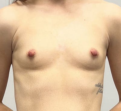 Breast Augmentation Before & After Gallery - Patient 132899333 - Image 1