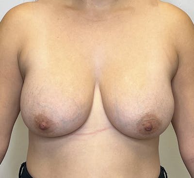 Breast Augmentation Before & After Gallery - Patient 132905248 - Image 2