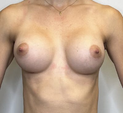 Breast Augmentation Before & After Gallery - Patient 132905633 - Image 2