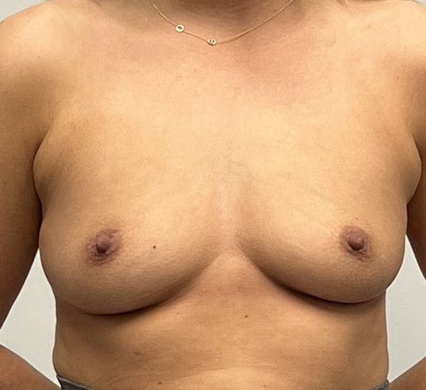 Breast Augmentation Before & After Gallery - Patient 132905866 - Image 1