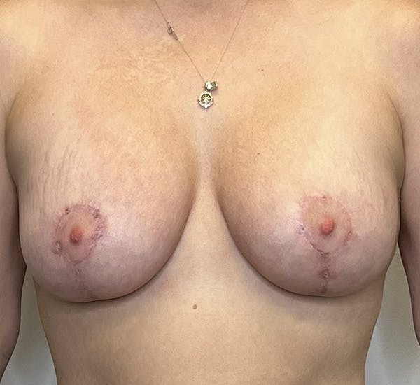 Breast Augmentation with Mastopexy Gallery - Patient 132906266 - Image 2