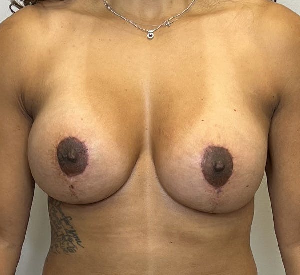 Breast Revision Surgery Before & After Gallery - Patient 132906424 - Image 2
