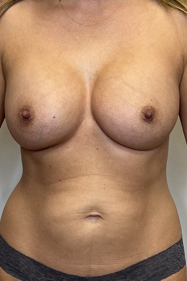 Liposuction Before & After Gallery - Patient 132906652 - Image 2