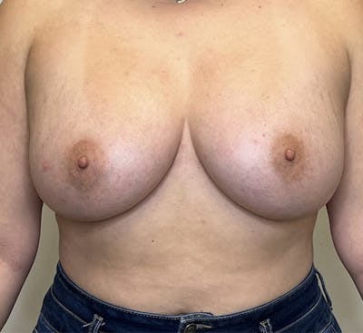 Breast Augmentation Before & After Gallery - Patient 142991660 - Image 2